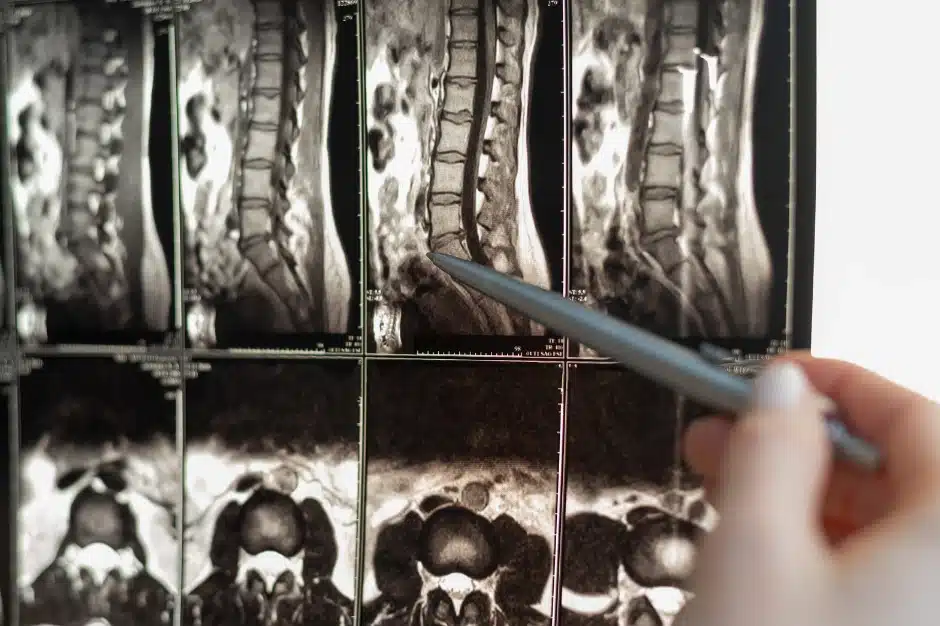 Disability for spinal stenosis, imaging of spine, Disparti Law Group
